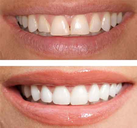 Before & After Teeth Shaping