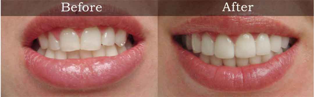 Teeth Shaping in Lindsay