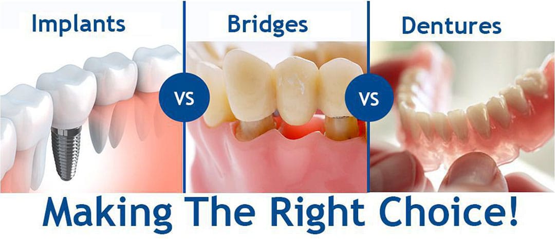 Implants, Bridges or Dentures